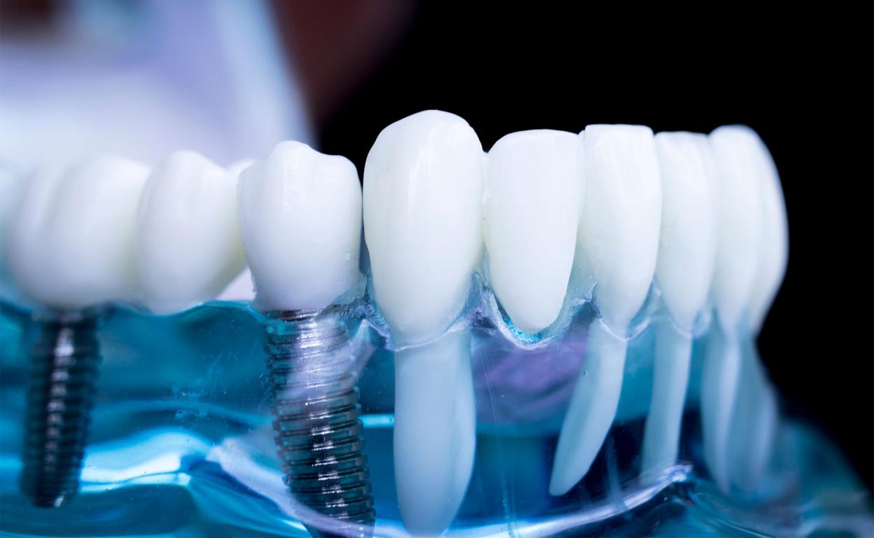 Типы зубных имплантатов. Имеет ли значение материал?