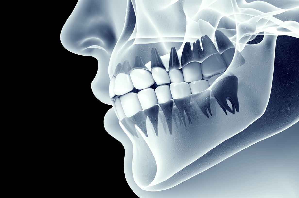 Миниатюра к статье Рентген зуба: для чего это нужно?