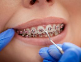 Миниатюра к статье Ортодонтия: 5 современных методов коррекции прикуса