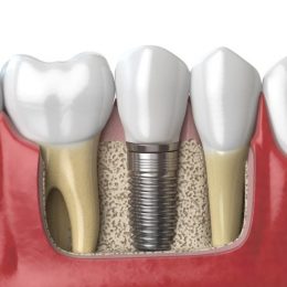 Миниатюра к статье Какой зубной имплант выбрать? Какие противопоказания?