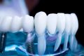 Миниатюра к статье Типы зубных имплантатов. Имеет ли значение материал?